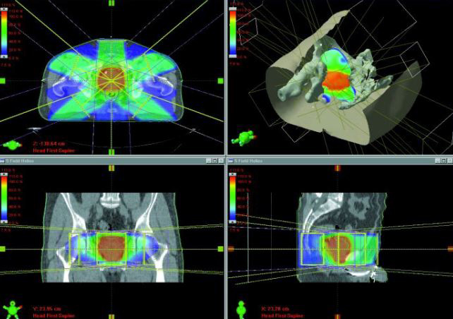 Prostatakarzinom: Strahlentherapie Pasing